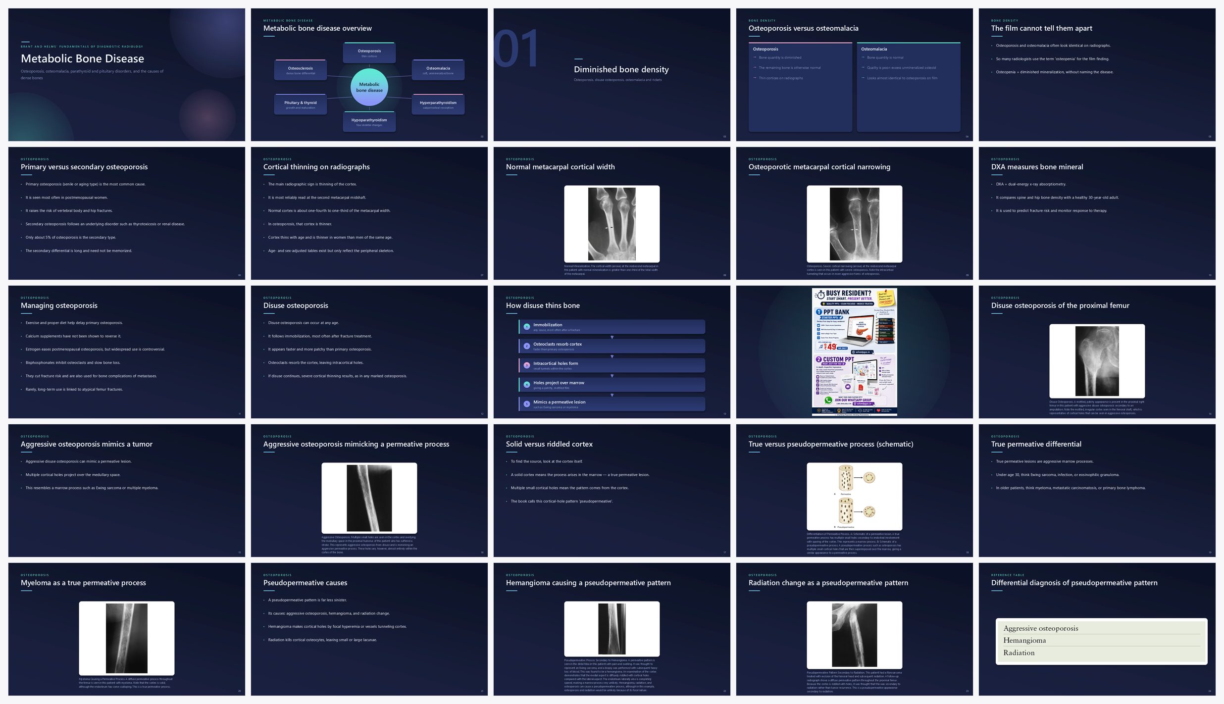 Preview of the first 25 slides of Metabolic Bone Disease