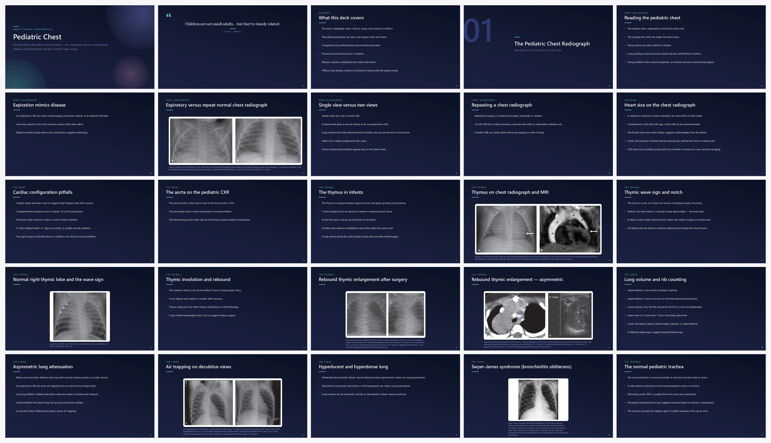 Preview of the first 25 slides of Pediatric Chest