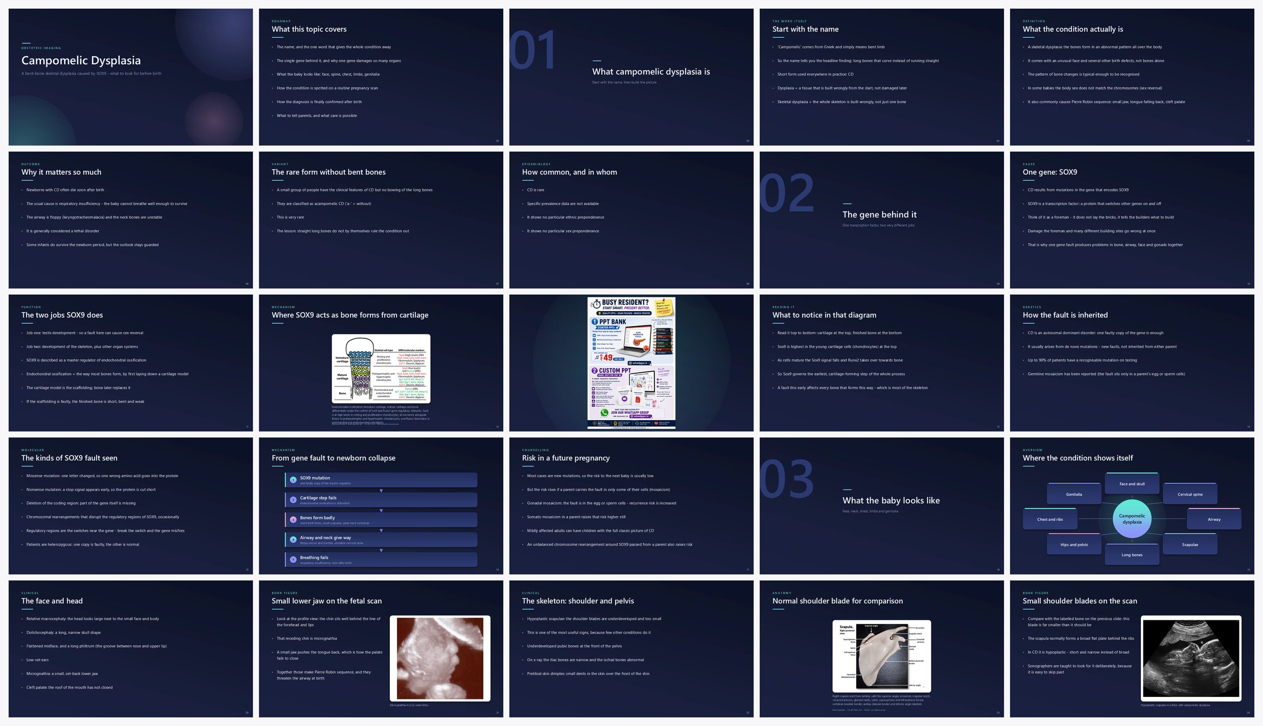 Preview of the first 25 slides of Campomelic Dysplasia