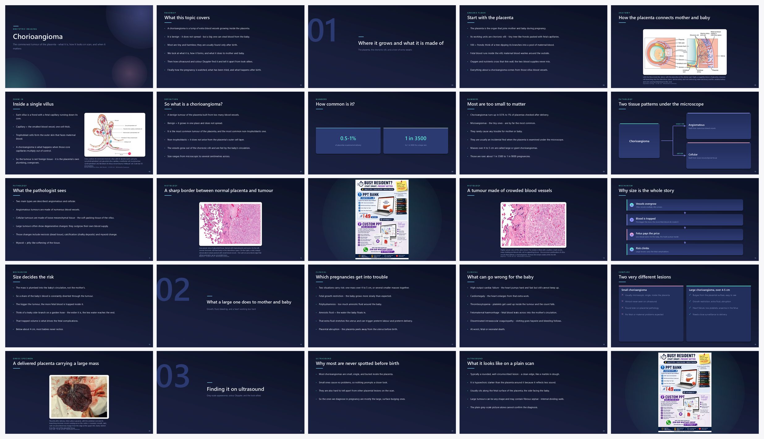 Preview of the first 25 slides of Chorioangioma