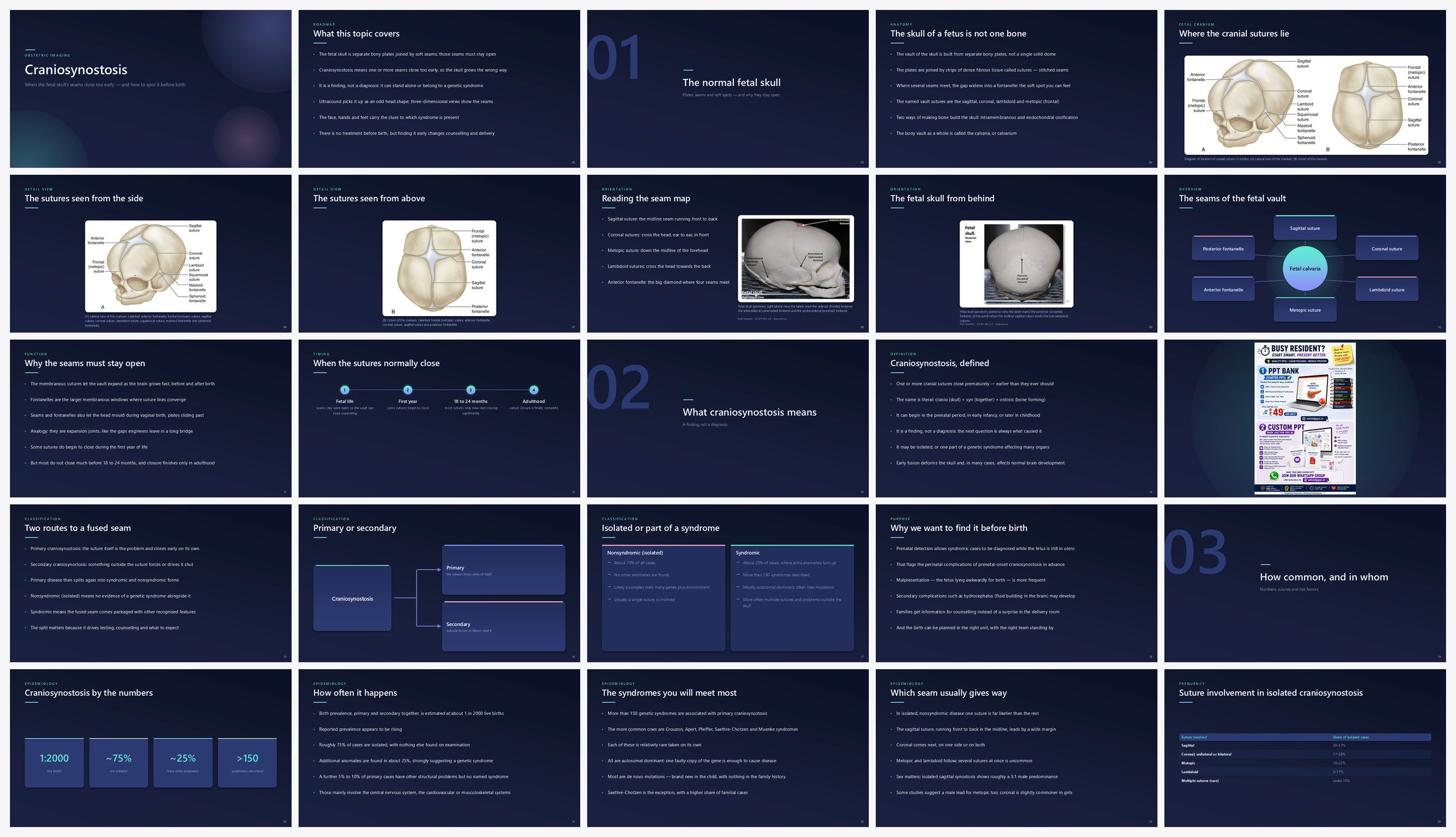 Preview of the first 25 slides of Craniosynostosis