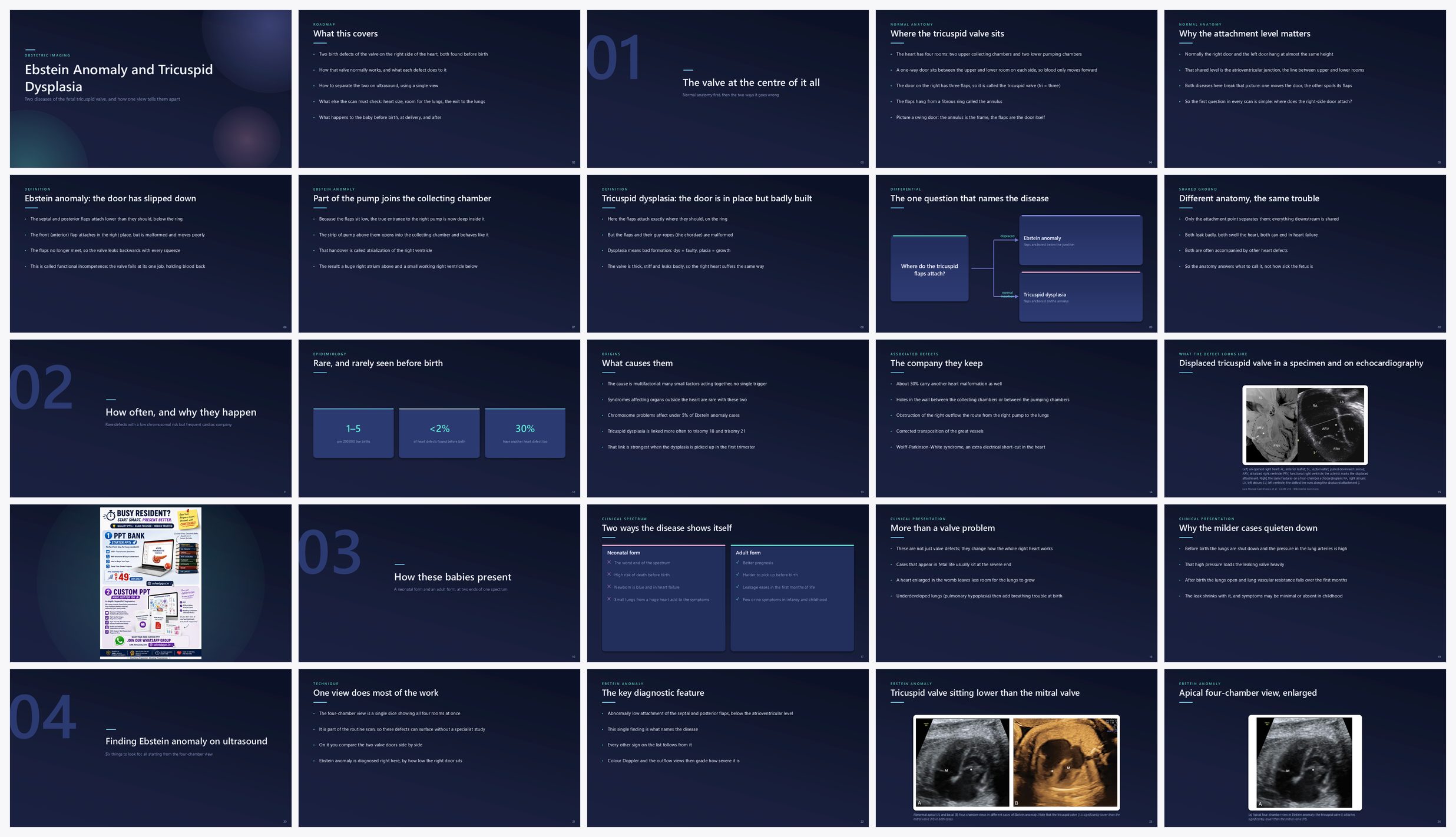 Preview of the first 25 slides of Ebstein Anomaly and Tricuspid Dysplasia