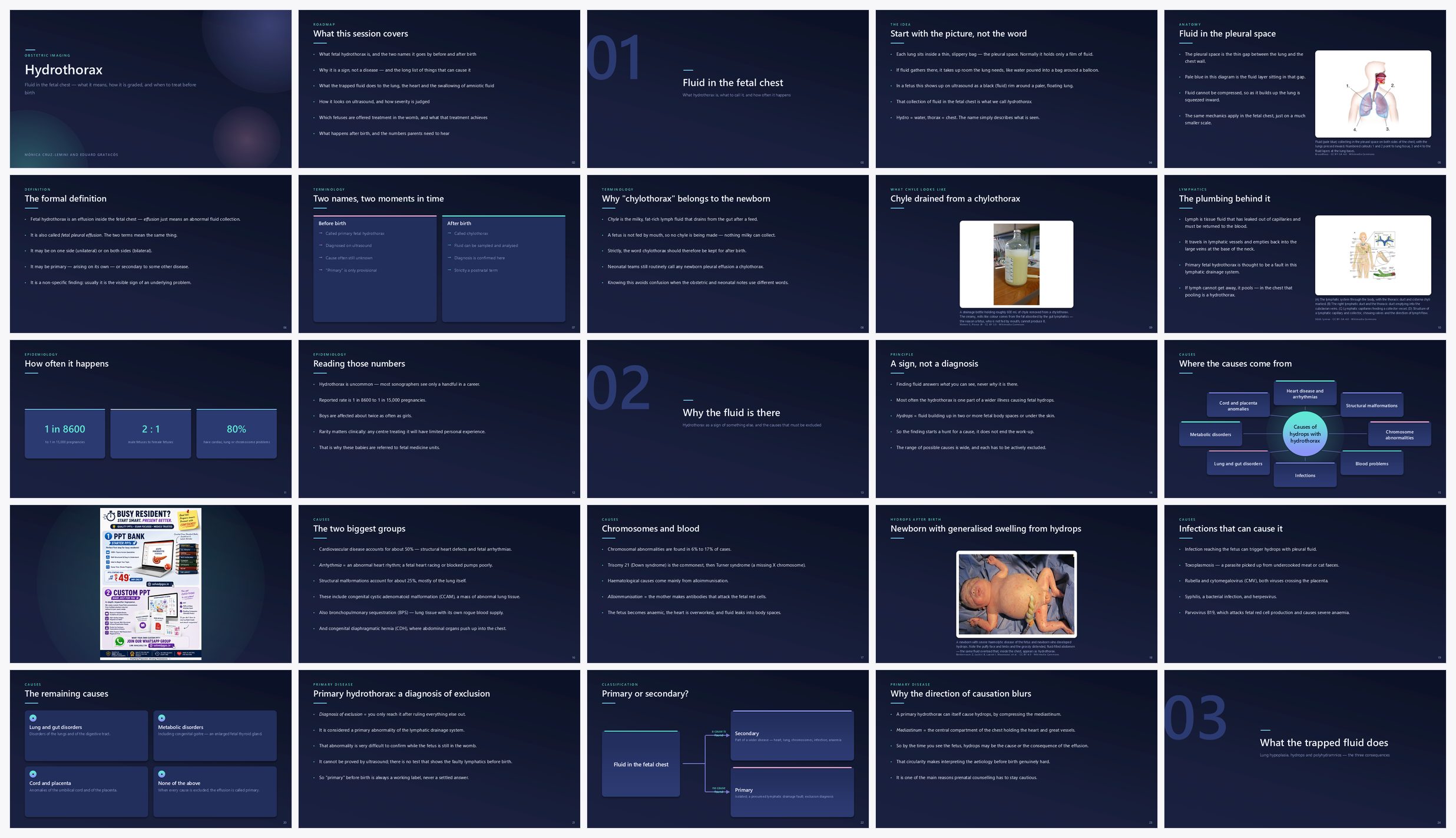Preview of the first 25 slides of Hydrothorax