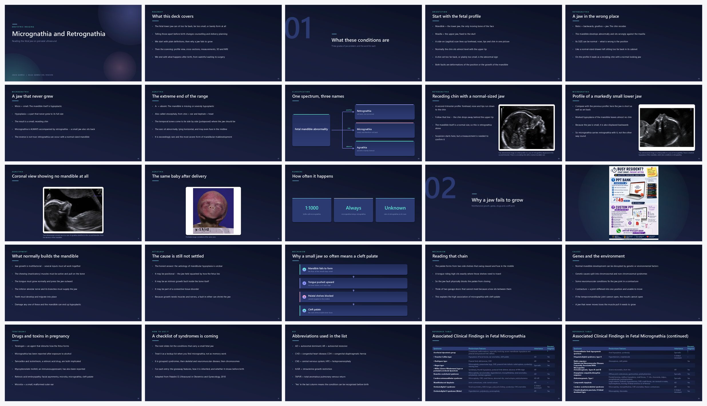 Preview of the first 25 slides of Micrognathia and Retrognathia