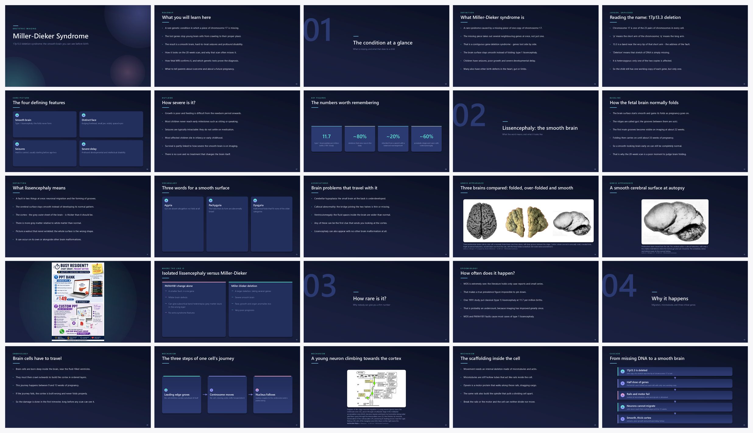 Preview of the first 25 slides of Miller-Dieker Syndrome (17p13.3 Deletion Syndrome)