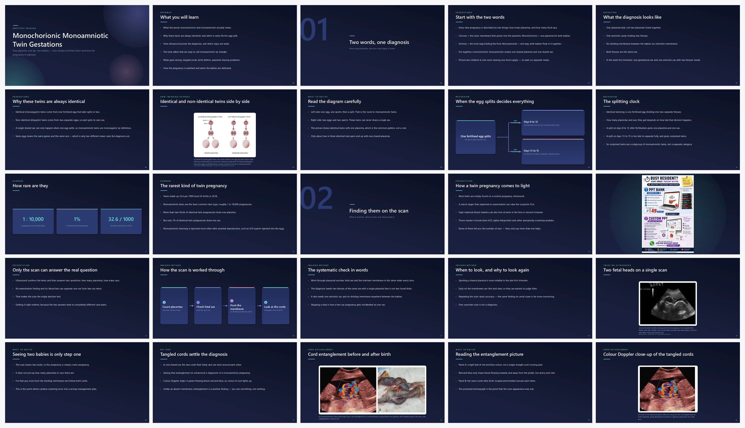 Preview of the first 25 slides of Monochorionic Monoamniotic Twin Gestations