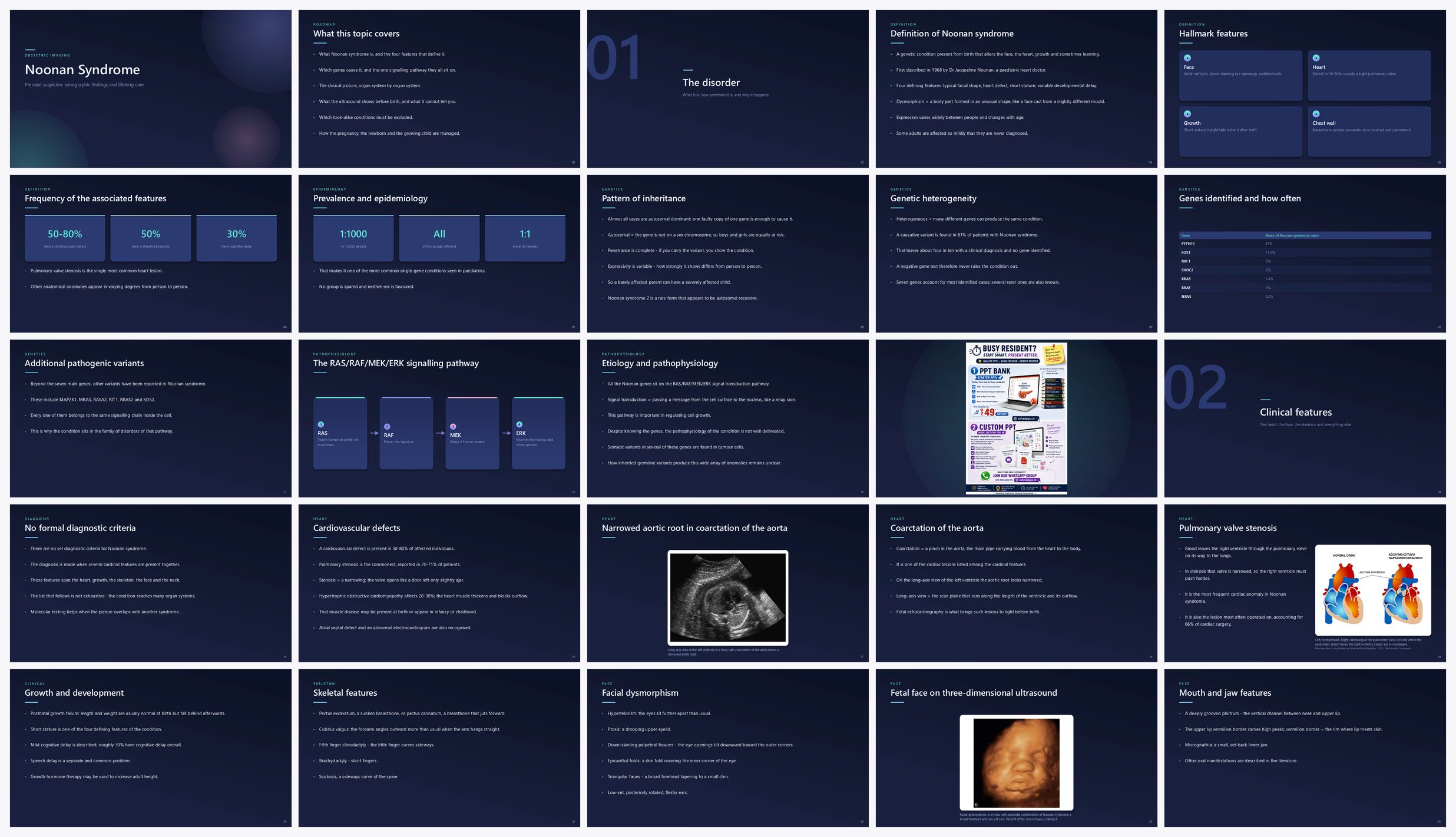 Preview of the first 25 slides of Noonan Syndrome