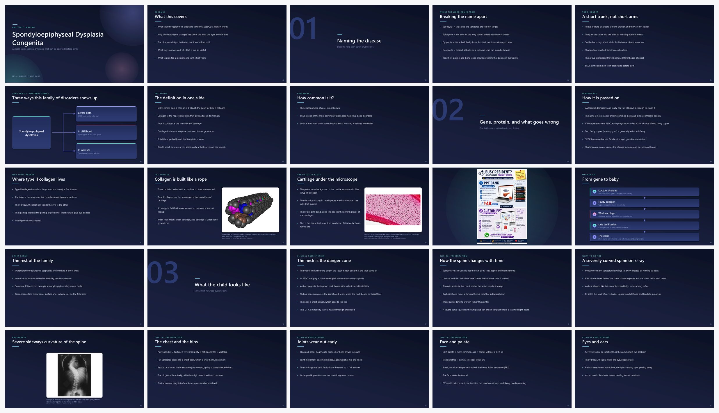 Preview of the first 25 slides of Spondyloepiphyseal Dysplasia Congenita