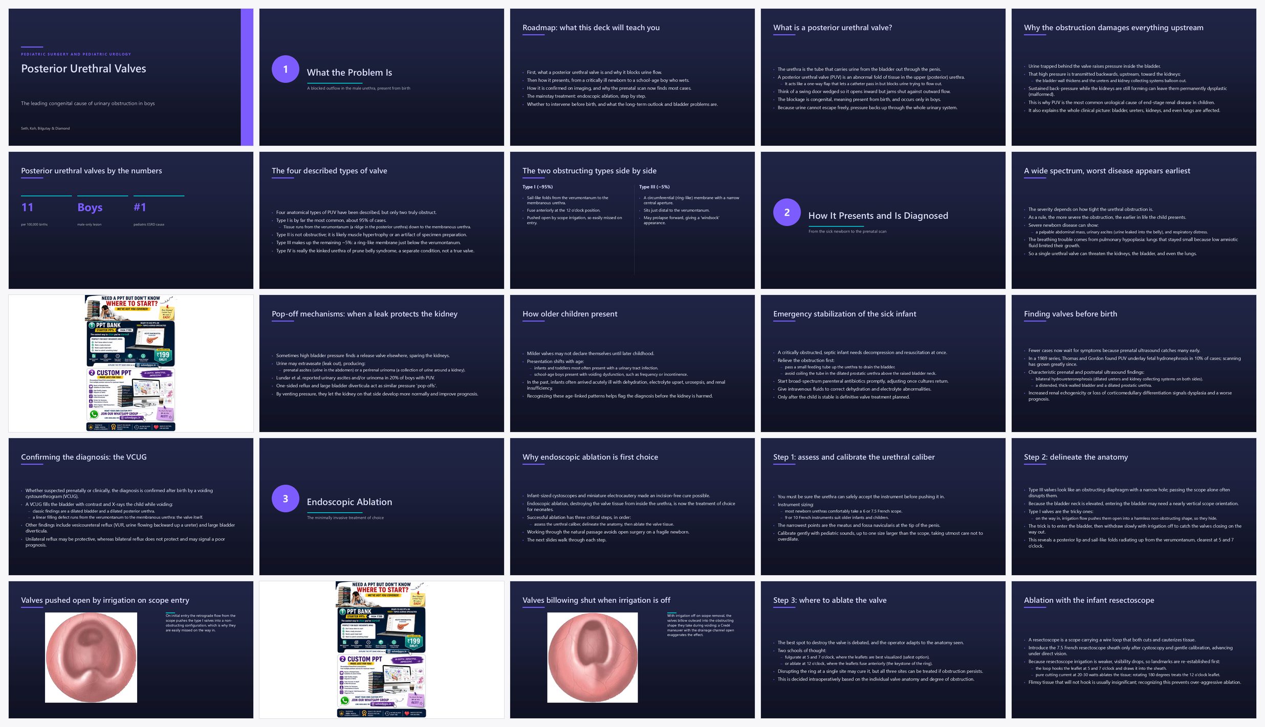 Preview of the first 25 slides of Posterior Urethral Valves