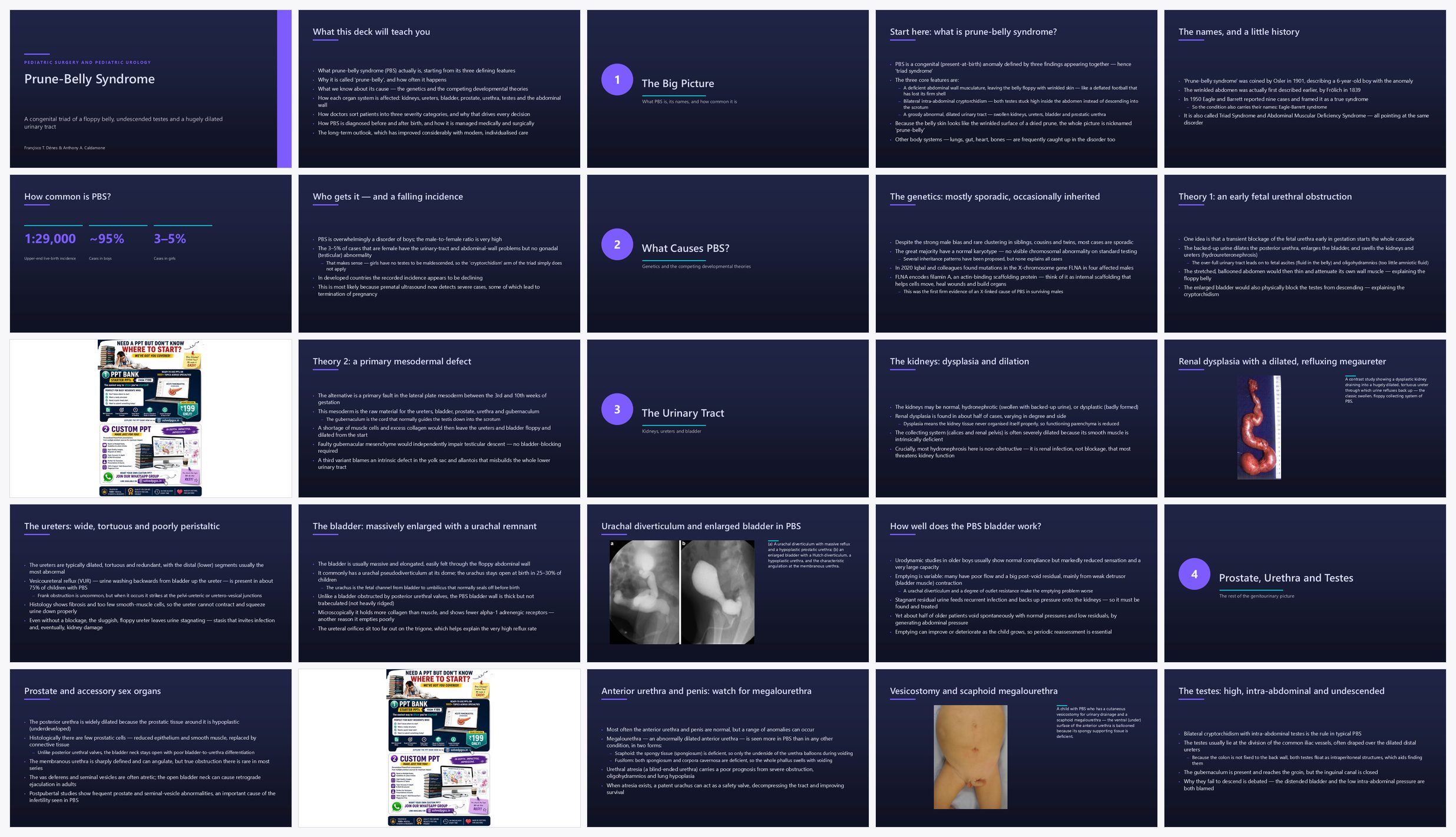 Preview of the first 25 slides of Prune Belly Syndrome